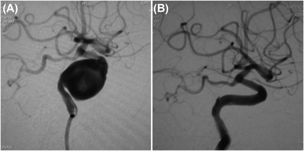 Oishi H and Sakai N Fig. 5 64-year-old male with asymptomatic right ICA aneurysm. (A) Pretreatment working projection.