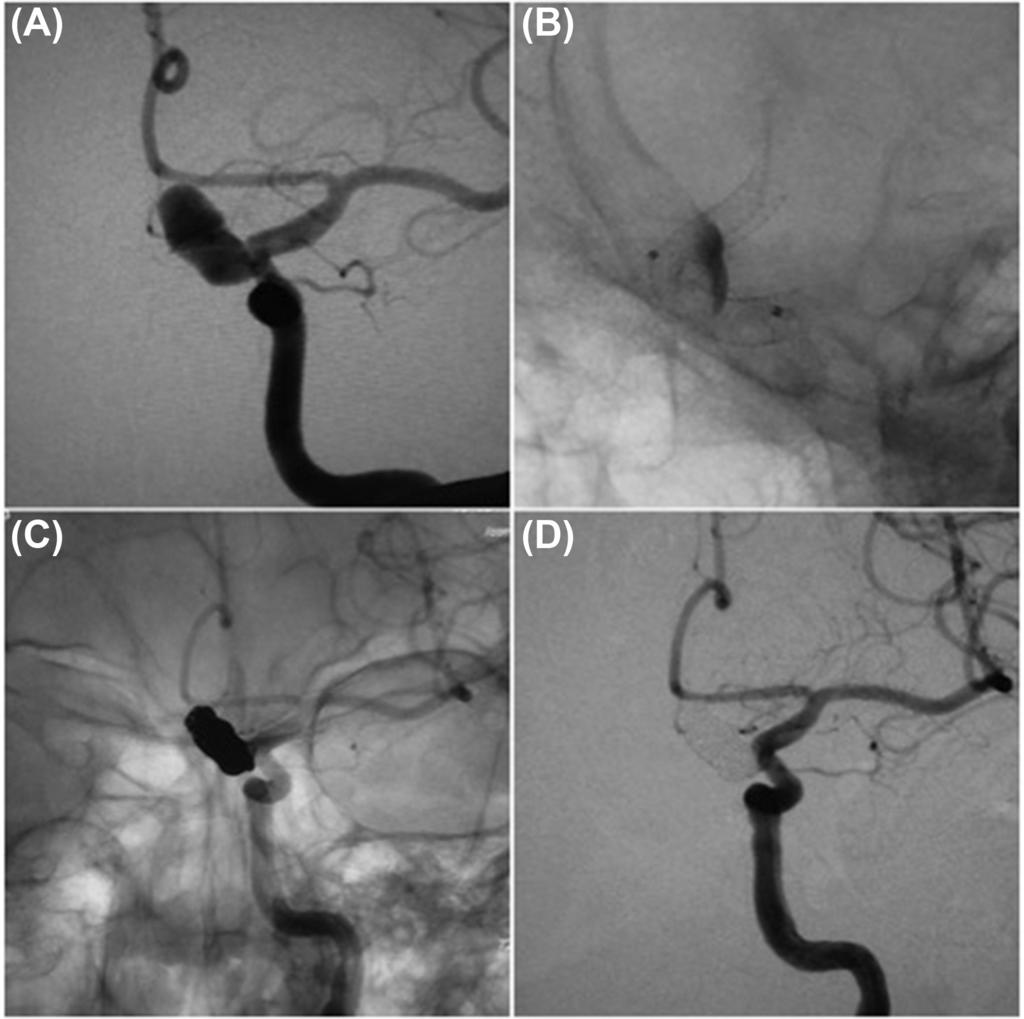 Repor t of Flow Diver ter Clinical Trials in Japan Fig. 7 67-year-old female with symptomatic left ICA aneurysm. The aneurysm showed risks of delayed rupture such as high aspect ratio >1.