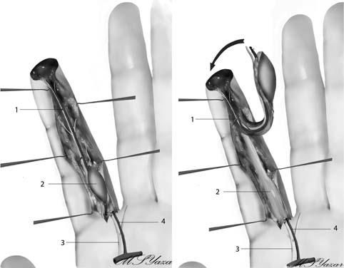 identified and cut from an appropriate level. The flap inset was done later. The contralateral transected digital nerve was coapted to the recipient nerve in the flap (Fig. 3a).