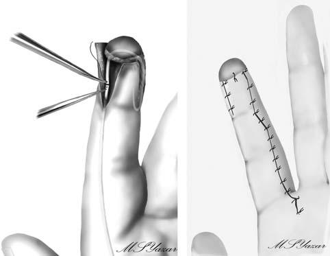 A dorsal splint was applied with the hand in an anatomical positon. The splint was removed 10 days later with the initiation of physiotherapy. Fig. 1. Finger-tip amputation.