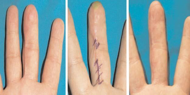 Hypersensitivity 2 (at flap) Contracture 3 (at incision site) Neuroma 2 fingertip is classified as Zone 1, and the zone between the nail bed and proximally to the DIP joint is designated as Zone 2.