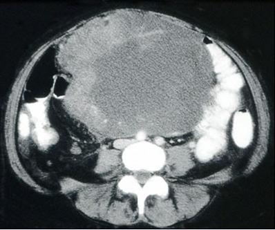 A CT scan showing a