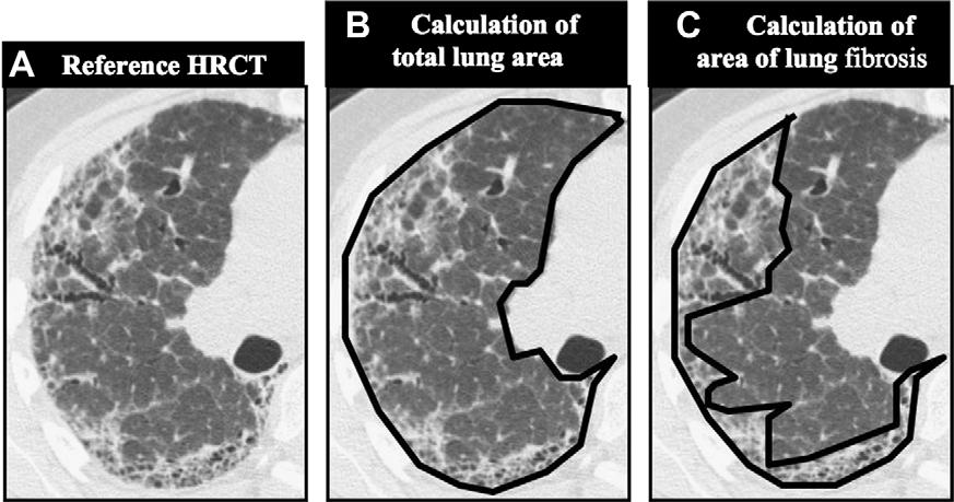 428 B.M. Elicker et al. Figure 1 Technique for calculating native lung area and % of fibrosis. Three images are shown, all at the same level.