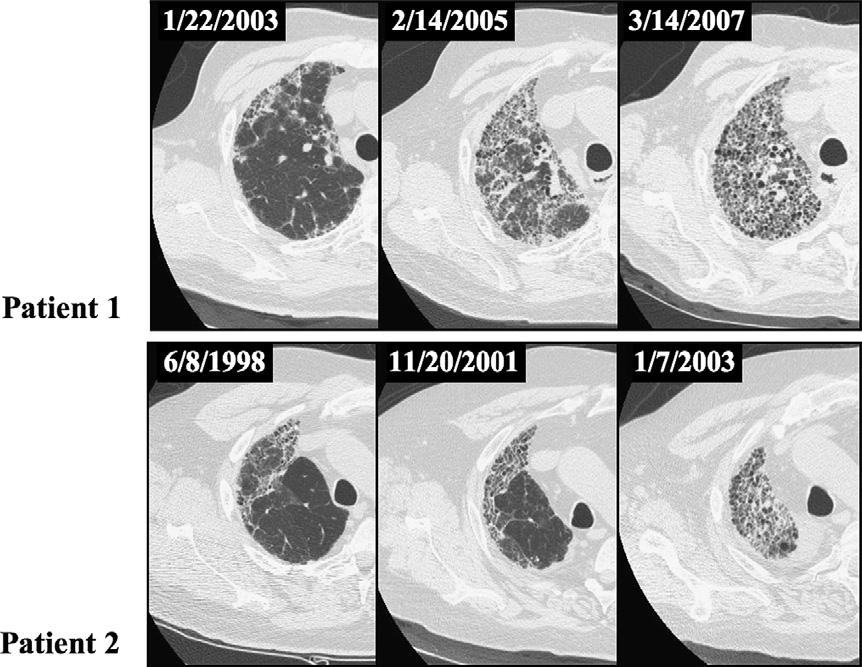 430 B.M. Elicker et al. Figure 2 Progression of native lung fibrosis over time in 2 different IPF patients status post unilateral lung transplant.