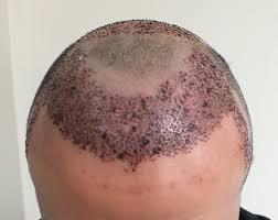 HAIR TRANSPLANT From 1950s-1990s, hair transplants had a very unnatural appearance plugs 3-4mm grafts containing 15-30