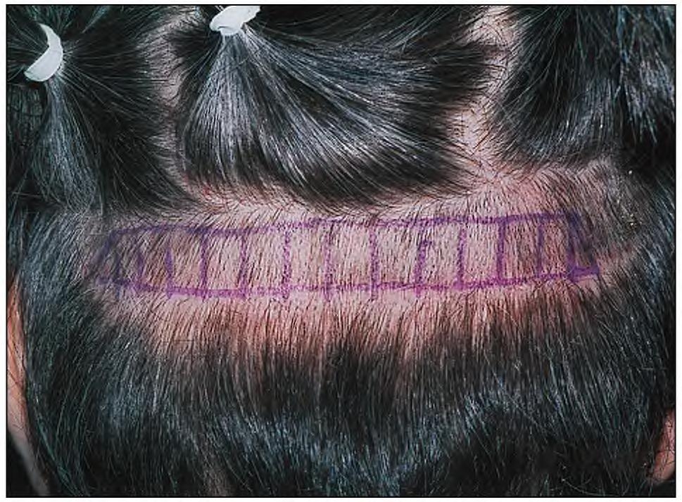 occipital scalp eliptical donor harvesting Recreate the hairline with grafts Patients are encouraged to continue minoxidil