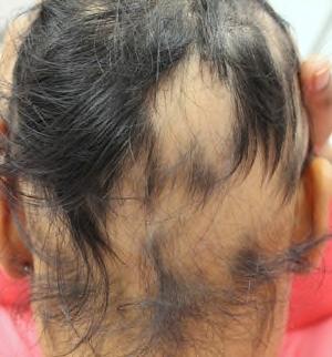 ALOPECIA AREATA Most commonly presents as round or oval patches of