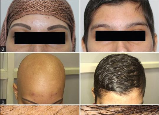 ALOPECIA AREATA TREATMENT Dependable and safe treatment for extensive disease has yet to be found, although