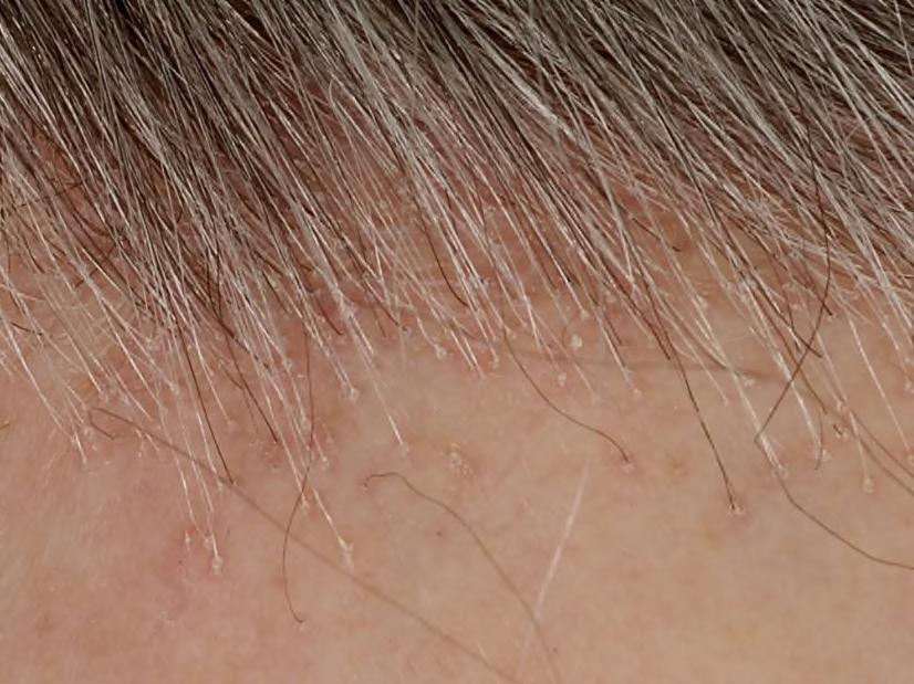 FRONTAL FIBROSING ALOPECIA AND LICHEN PLANOPILARIS Inflammatory scarring alopecia with several different patterns of hair loss Often presents with pruritus and tenderness