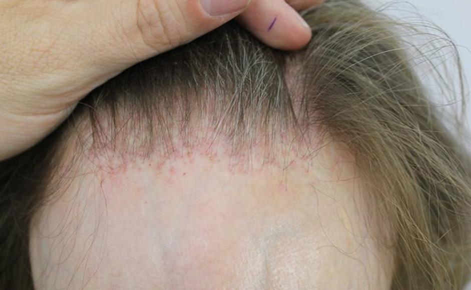 FRONTAL FIBROSING ALOPECIA/LICHEN PLANOPILARIS Treatment of limited disease Inject the margin with intralesional triamcinolone