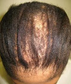 CENTRAL CENTRIFUGAL CICATRICIAL ALOPECIA (CCCA) Responsible for more cases of scarring alopecia in African Americans than all other types of scarring alopecia combined