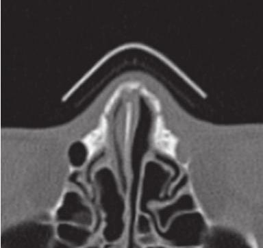 the nasal bone reduction procedure. We analyzed the frequency of nasal bleeding with IOR and R operations.