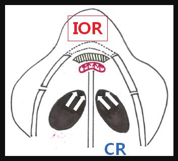 () Schematic illustration of cross-sectional nasal view showing the superiority of indirect open reduction (IOR) for the reduction of depressed nasal tip fracture compared to closed