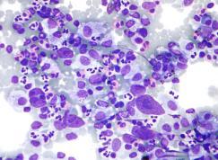 NHL :DIAGNOSIS AND TREATMENT Biopsy Staging Chemotherapy is treatment of choice HODGKINS LYMPHOMA Less common than NHL Hodgkin's lymphoma is characterized by the orderly spread of disease from one