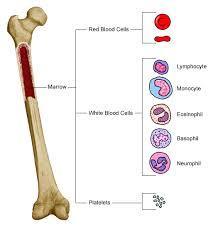 Leukaemia BMT LEUKAEMIA: SIGNS AND SYMPTOMS Bone marrow infiltration Anaemia with pallor, lethergy, dyspnoea Low