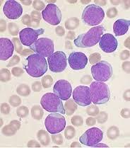 LEUKAEMIA :DIAGNOSIS Peripheral blood smear Immunophenotyping and