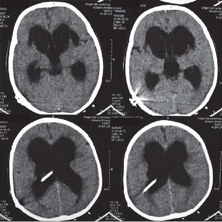 BRAIN TUMOURS: DIAGNOSIS Neuro imaging is