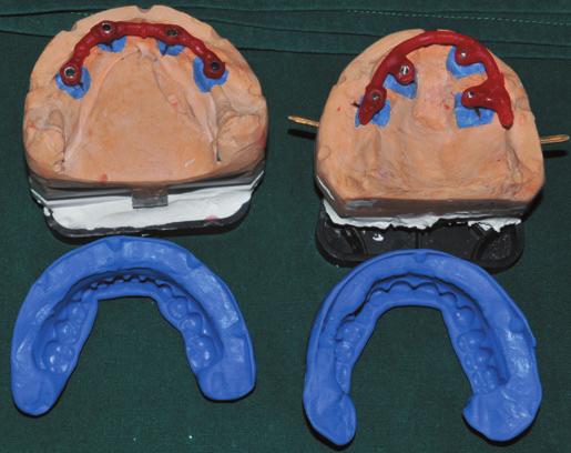 intra-al try-in. After confirming the vertical dimension, aesthetics, speech and occlusion with the wax trial dentures, remove and refit them back on to the wking casts (Fig. ).