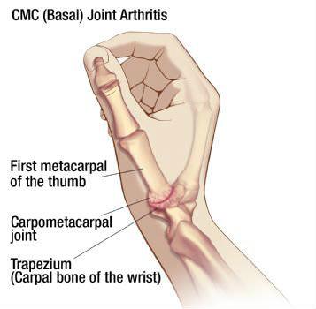 1 st Metacarpal Phalangeal Joint Indication First