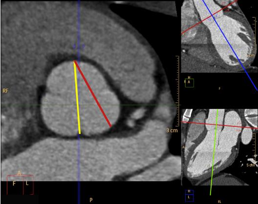 CT and MRI Inner to Inner Must use multi-plane reconstruction