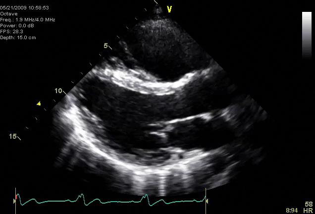 PLAX Normal size and mild reduced systolic LV function