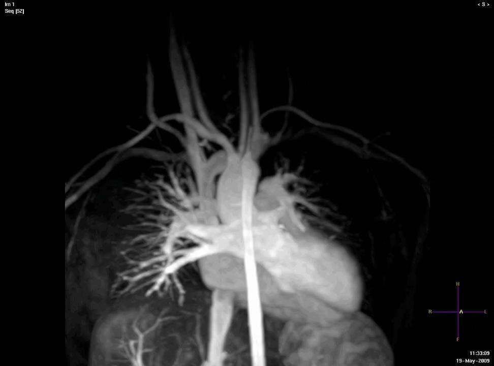 MR Angiogram No pulmonary artery stenosis No aortic dilation Tan.