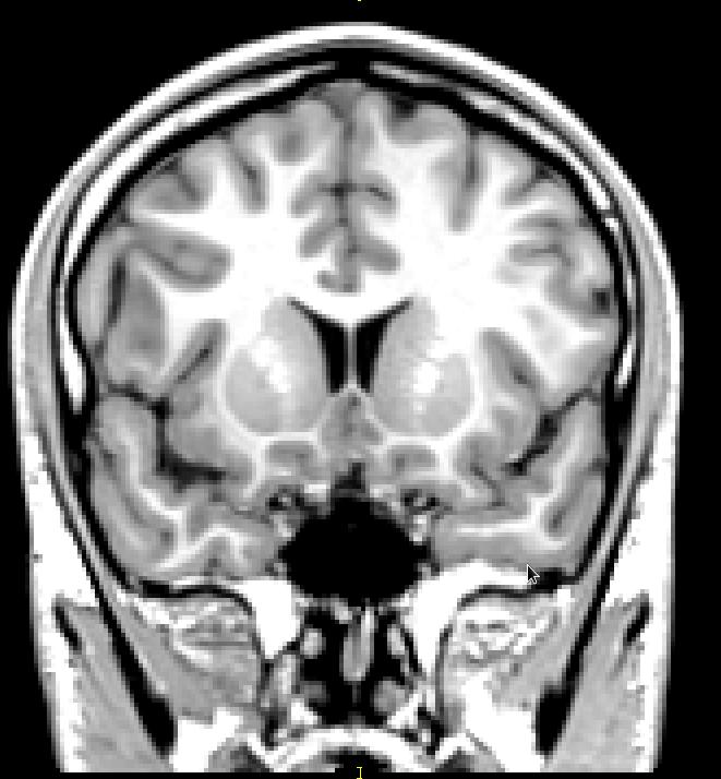 Magnetic Resonance Image (MRI) Gray Matter Dendrites Cell Bodies Synapses Cerebral
