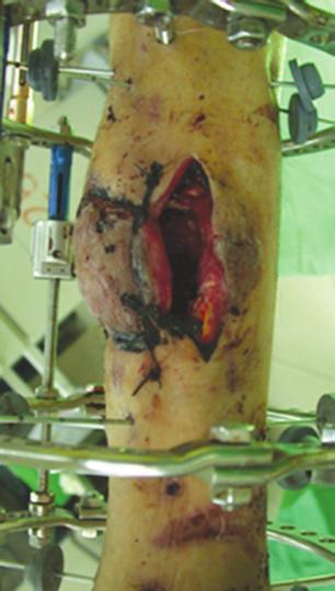 Although autogenous bone grafting may be used to fill bone defects, donor-site morbidity and insufficiency exist in large segmental defects, in which case the autogenous bone grafting could be