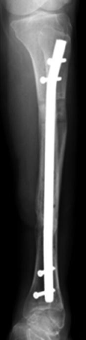 Over the past 3 decades, external fixation has become a prominent method for 1A 1B 1C 1D 1E 1F 1G 1H Figure 1: After previous treatment of plating for open tibial fracture, the patient presented with