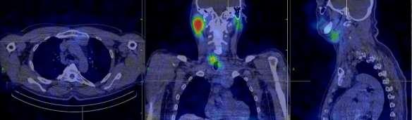 Thyroid carcinoma metastases,