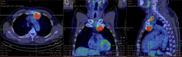 SPECT-CT examination following