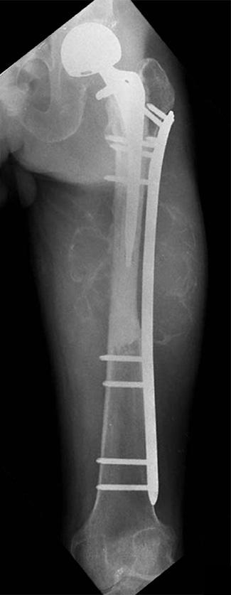 Fractures were located in the proximal femur in 2 cases, femoral mid-shaft in 3, distal femur in 3, proximal tibia in 4, and distal tibia in 1 (Fig. 1).