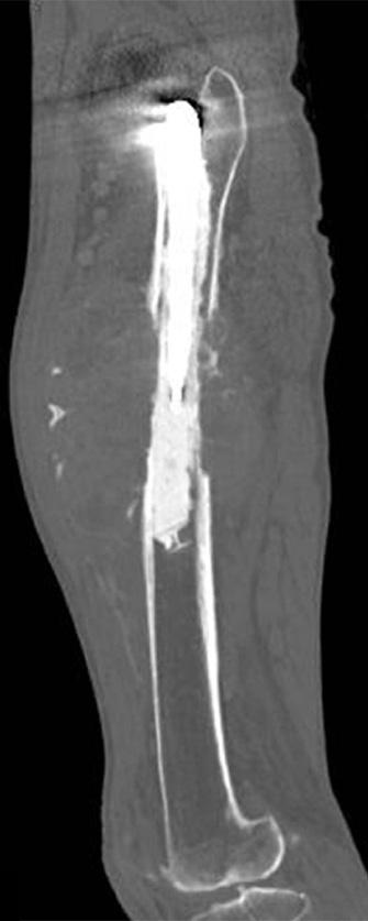 A 70-year-old man with a fracture of the distal femur secondary to metastasis of lung cancer.