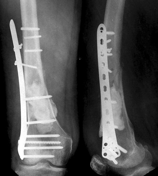 83 Metastatic Pathologic Fractures in Lower Extremities Treated with the Locking Plate which were difficult to use an intramedullary device.