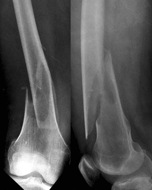 Tumor removal and locking plate fixation with bone cement augmentation were performed in 9 cases with considerable bony destruction (Table 1).