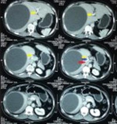 Figure 4: 2 nd CT scan shows accumulation of bile in the supracolic compartment.