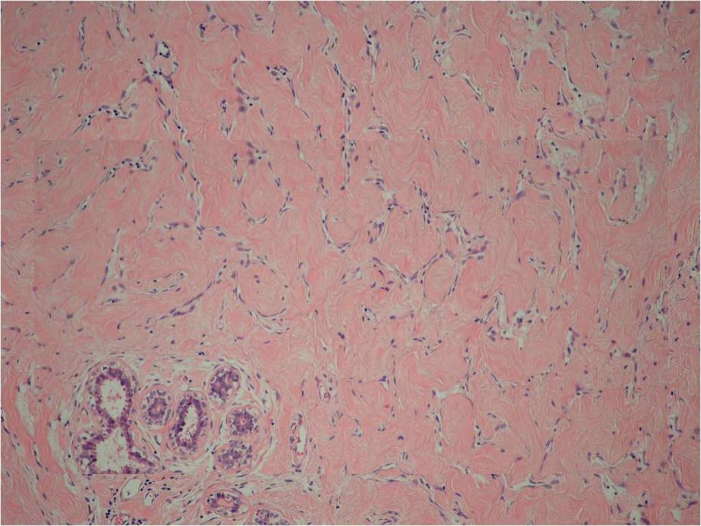 PASH Pseudo Angiomatous Stromal Hyperplasia 1986 Presentation Breast mass palpable or on screening Often painful or tender 1/3 Pre-menopausal women Pathology Hormone-dependent collagenous expansion