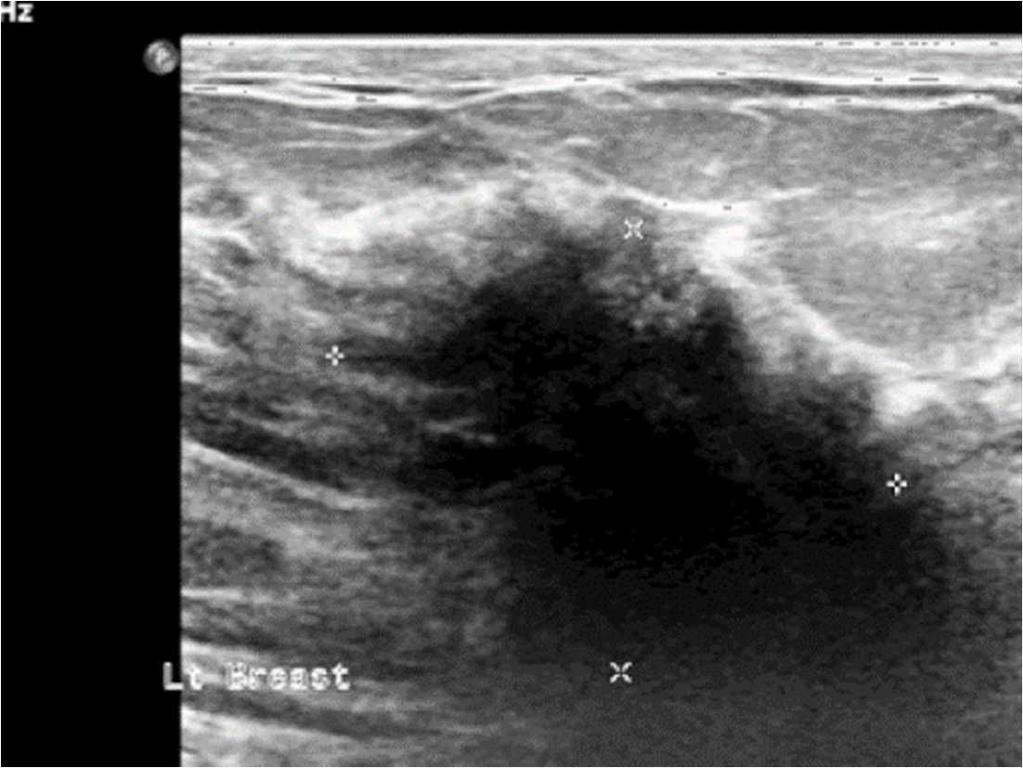 DIABETIC MASTOPATHY Sclerosing Lymphocytic Lobulitis Presentation Premenopausal diabetics Usually a large hard painless breast mass Imaging findings Mammogram