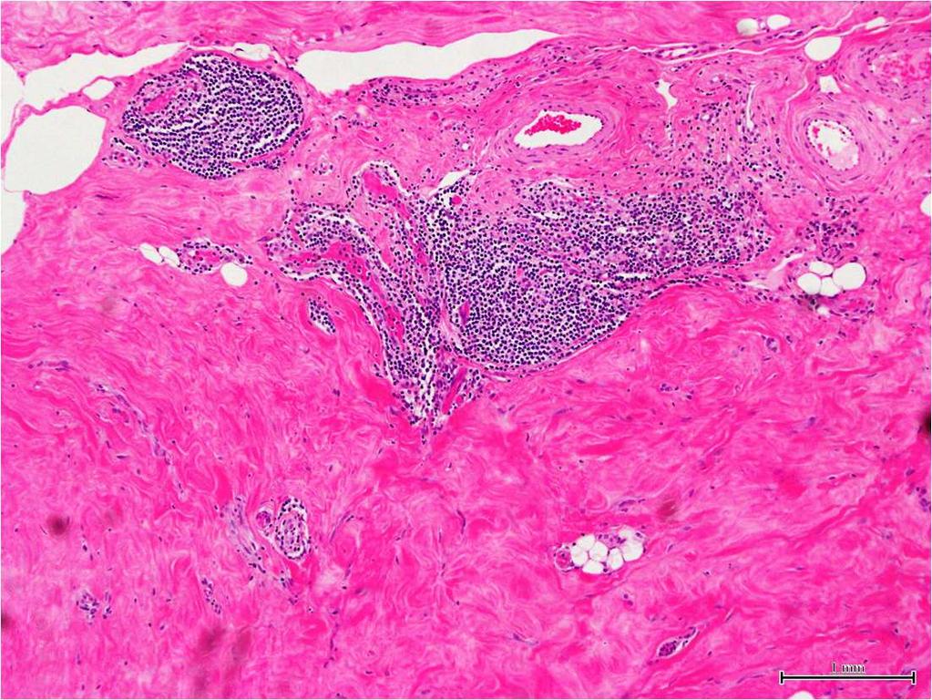 DIABETIC MASTOPATHY Pathology Prominent keloidal fibrosis and lymphocytic infiltrate DD Extra-nodal MALT lympho`ma