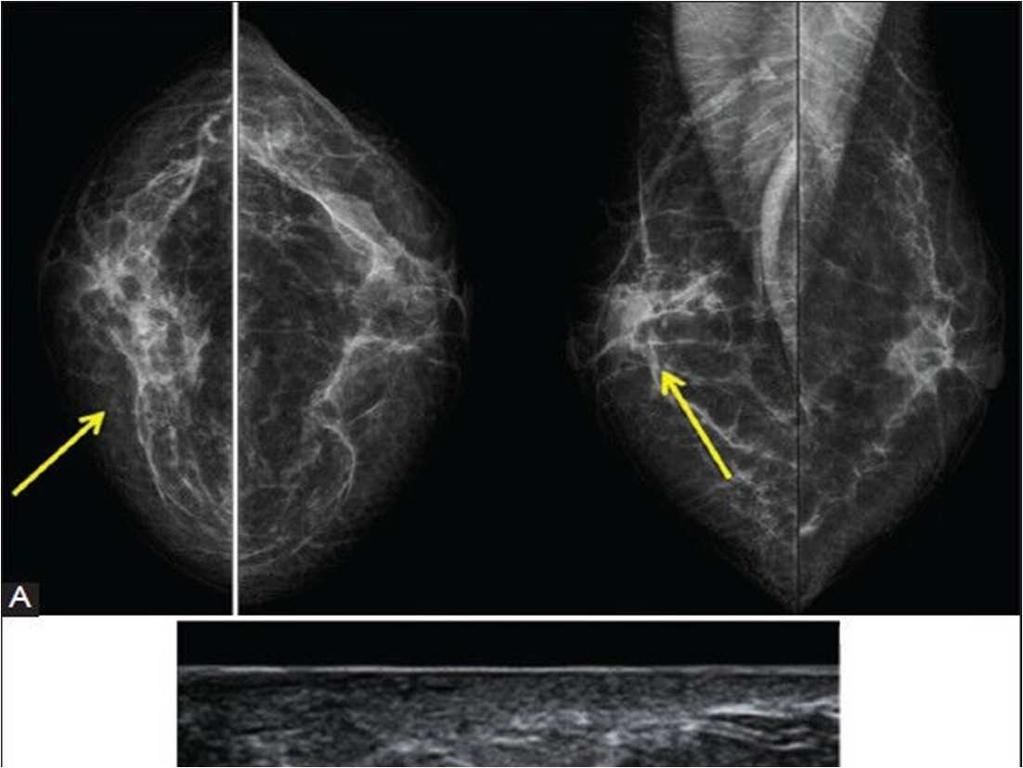 Epworth HealthCare 13 FAT NECROSIS Imaging findings Early - haematoma a superficial mass on mammography Tomo shows lobulation with well-defined margins echogenic mass with cystic spaces on U/S Later