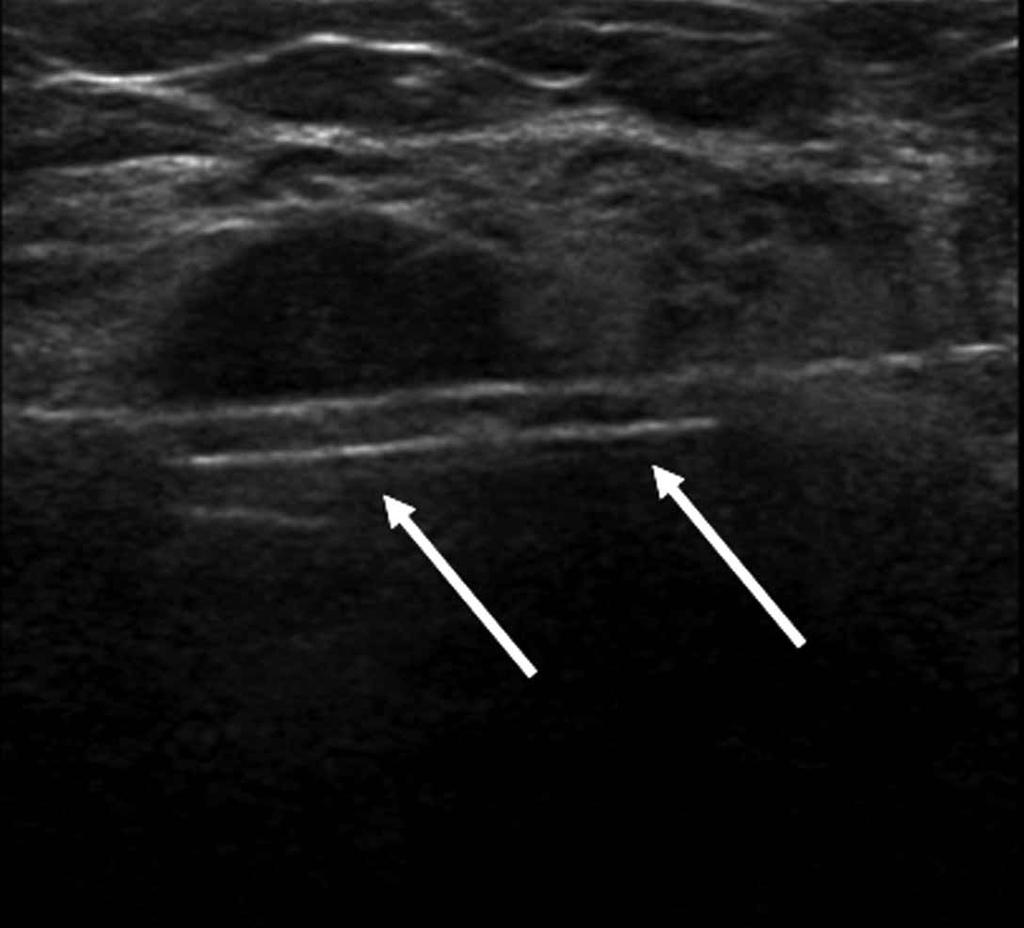 Two days after the original procedure, the second follow-up sonogram showed that the PA had spontaneously thrombosed. Color Doppler images revealed no flow (Figure 6).