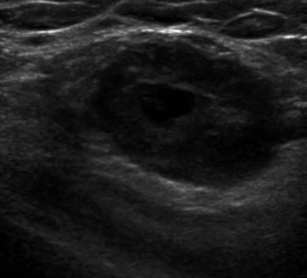 Sonogram showing a mass in the right upper outer quadrant that is well defined but with a partially indistinct margin (arrow).