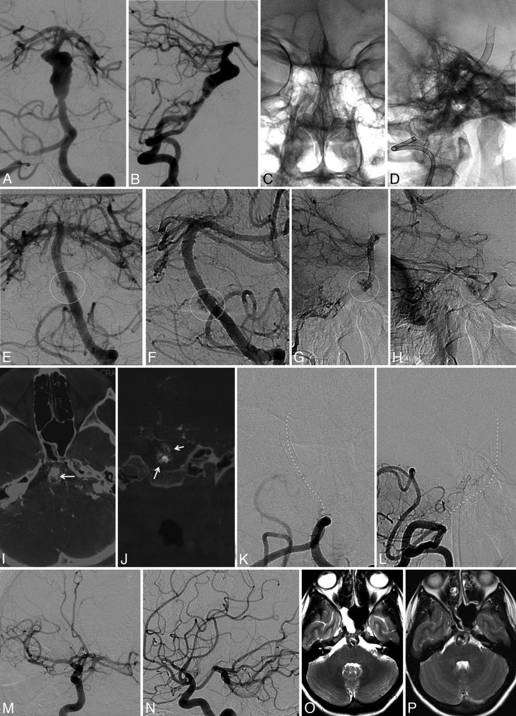 Fig 1. Subtracted PA (A) and lateral (B ) pretreatment angiographic projections demonstrate a fusiform aneurysm with incorporation of a 20-mm segment of the midbasilar trunk.