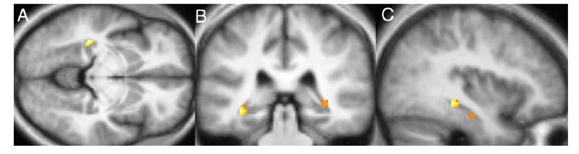 Mindfulness Changes in gray matter concentration in brain regions involved in learning and memory processes,