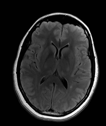 MRI Oct 2011 MRI & Lumbar Puncture CSF <1 WCC, no growth Glu 3 (plasma 4.5) Prot 0.