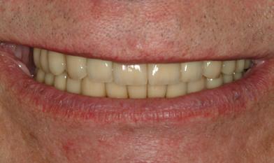 maxillary and mandibular anterior teeth. Phase I: Initial Therapy Comprehensive oral and facial examinations were completed prior to formulation of the treatment plan.