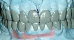 Frontal view of the diagnostic wax-up and orthodontic setup in centric occlusion Frontal view of the diagnostic wax-up in centric
