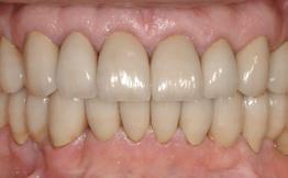 Surgical aesthetic crown lengthening was planned to expose 1.5 mm of the maxillary anterior teeth structure.
