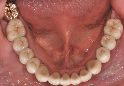 A surgical template was fabricated from the diagnostic waxup and was used as a reference during surgery for locating the prospective free gingival margins.