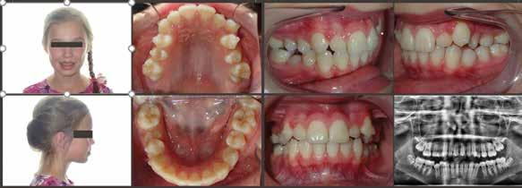 When the time is right, we would then offer Phase 2 treatment and complete her treatment with the full complement of adult teeth.